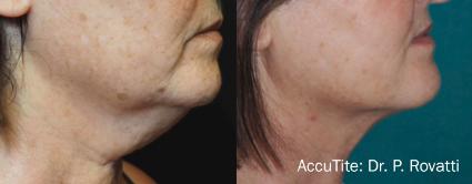 AccuTite Skin Tightening Before & After Case 43
