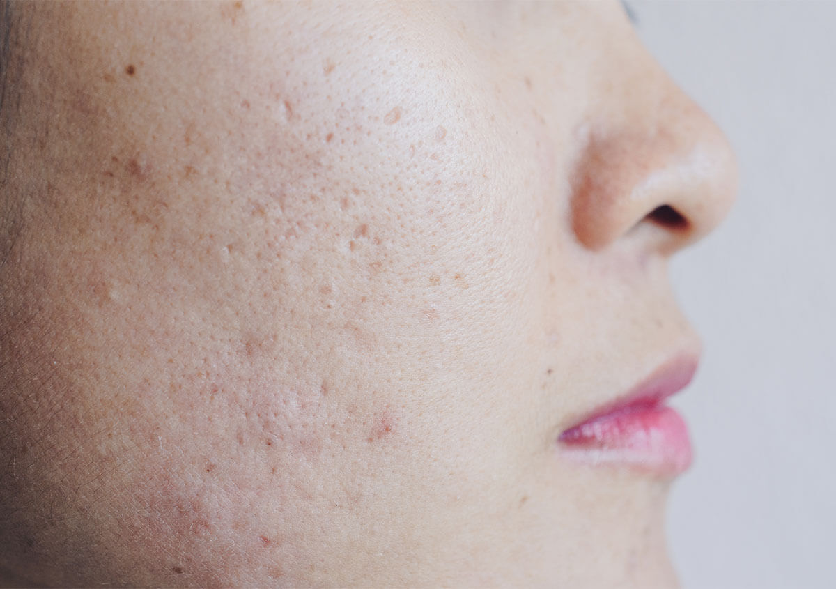 Acne Scarring Laser Treatment in Guelph ON Area