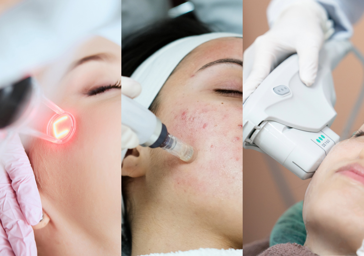 CO2 Laser Resurfacing